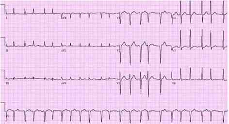 ecg