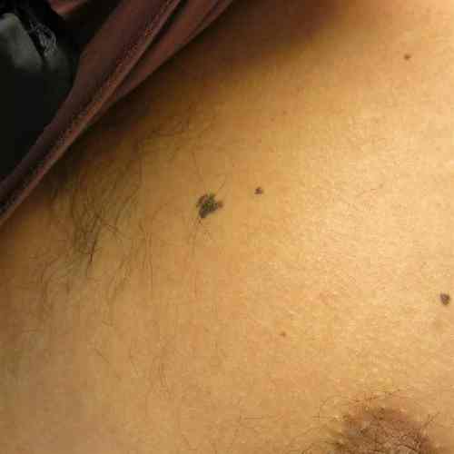 Dermal Nevus Globular Pattern Irregular borders Male 26 yrs Chest Clin