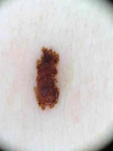 SSM 0.5 mm Mit No Ulc Axilla Female 49 yrs Derm