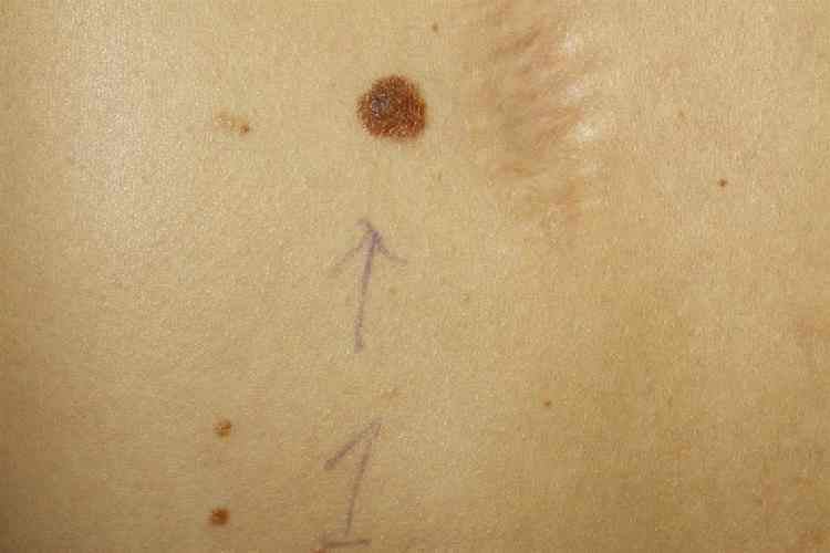 Compound Nevus Back Female 23 yrs Clin 2