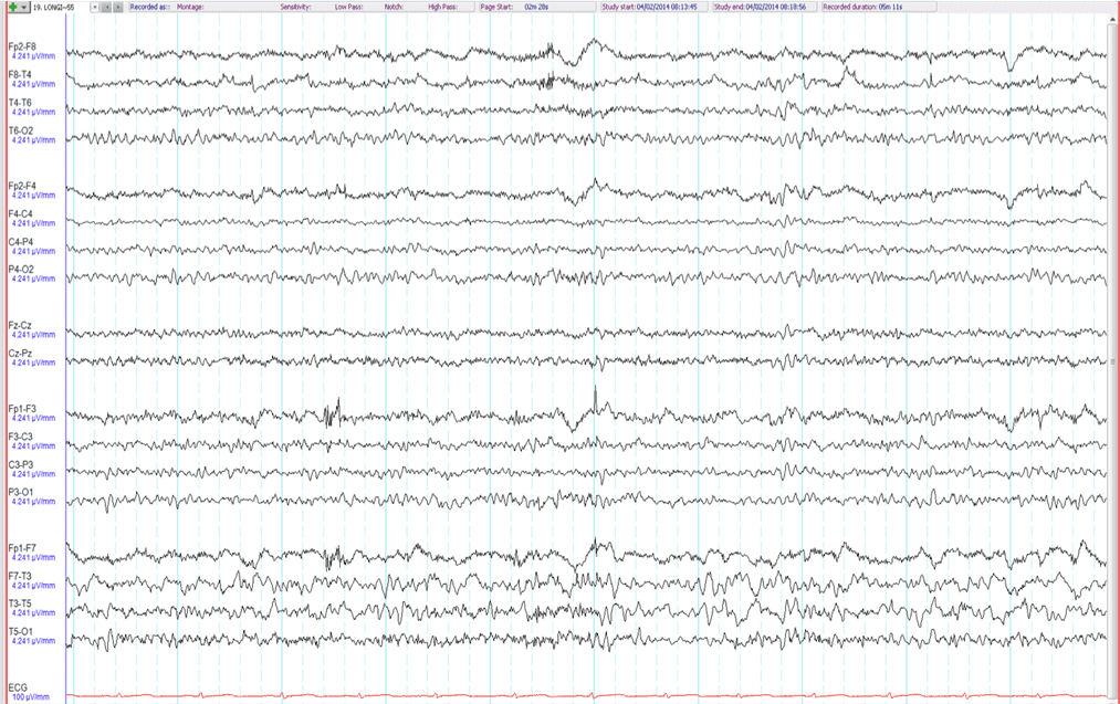 ANZAN EEG Course Quiz 2019 GOOD Take the Quiz QuizMaker