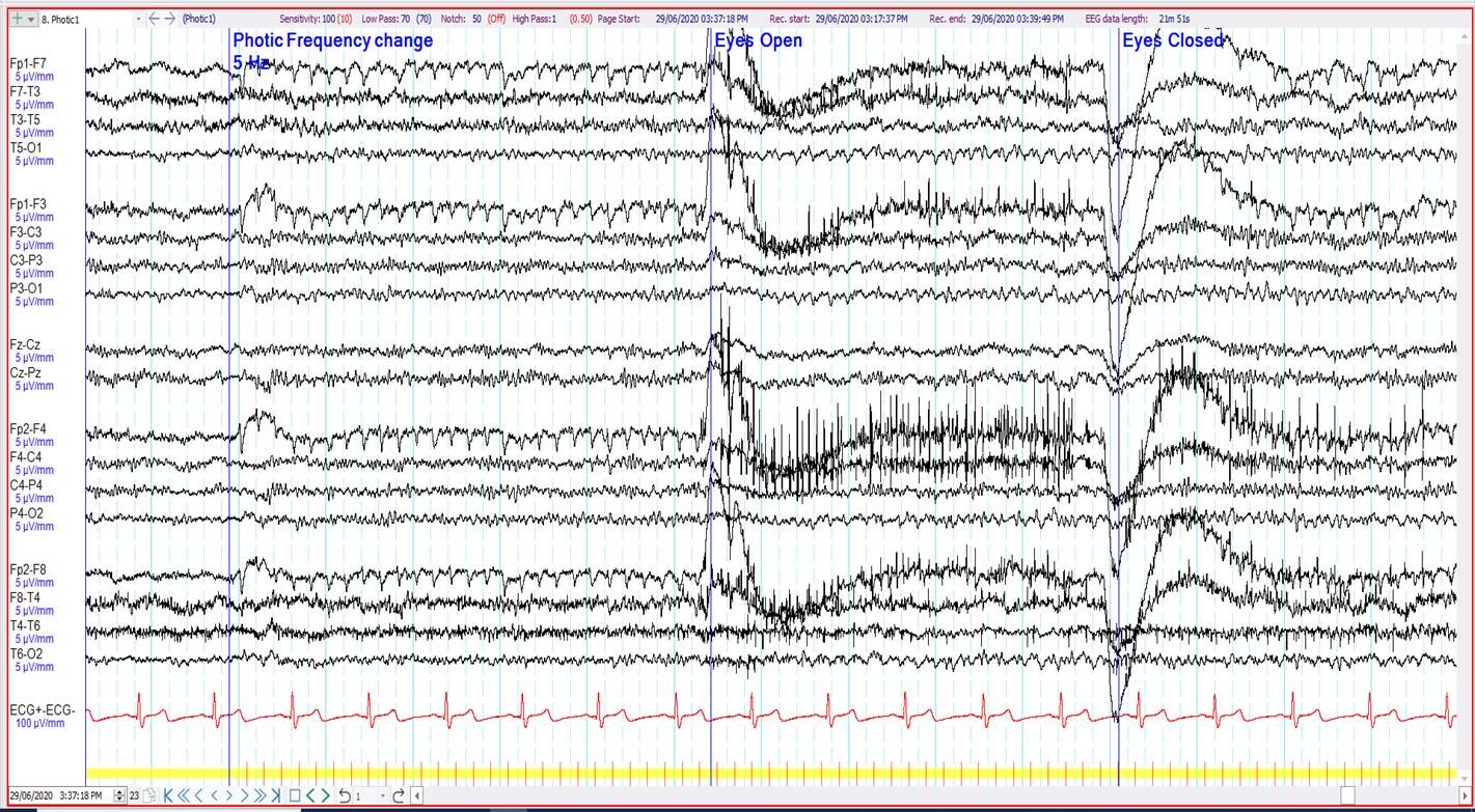 ERG at 5 Hz