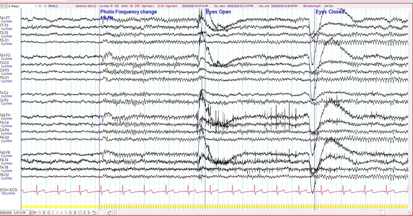 ERG at 10 Hz